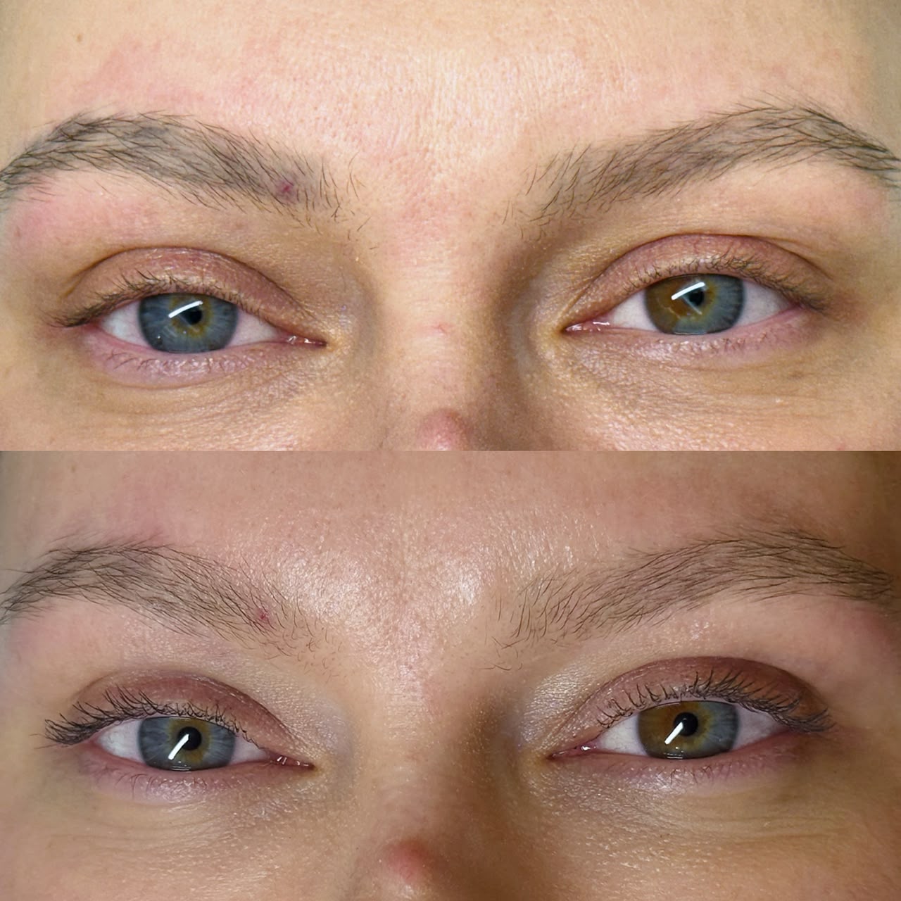 Remoção a Laser: Clareamento de micropigmentação