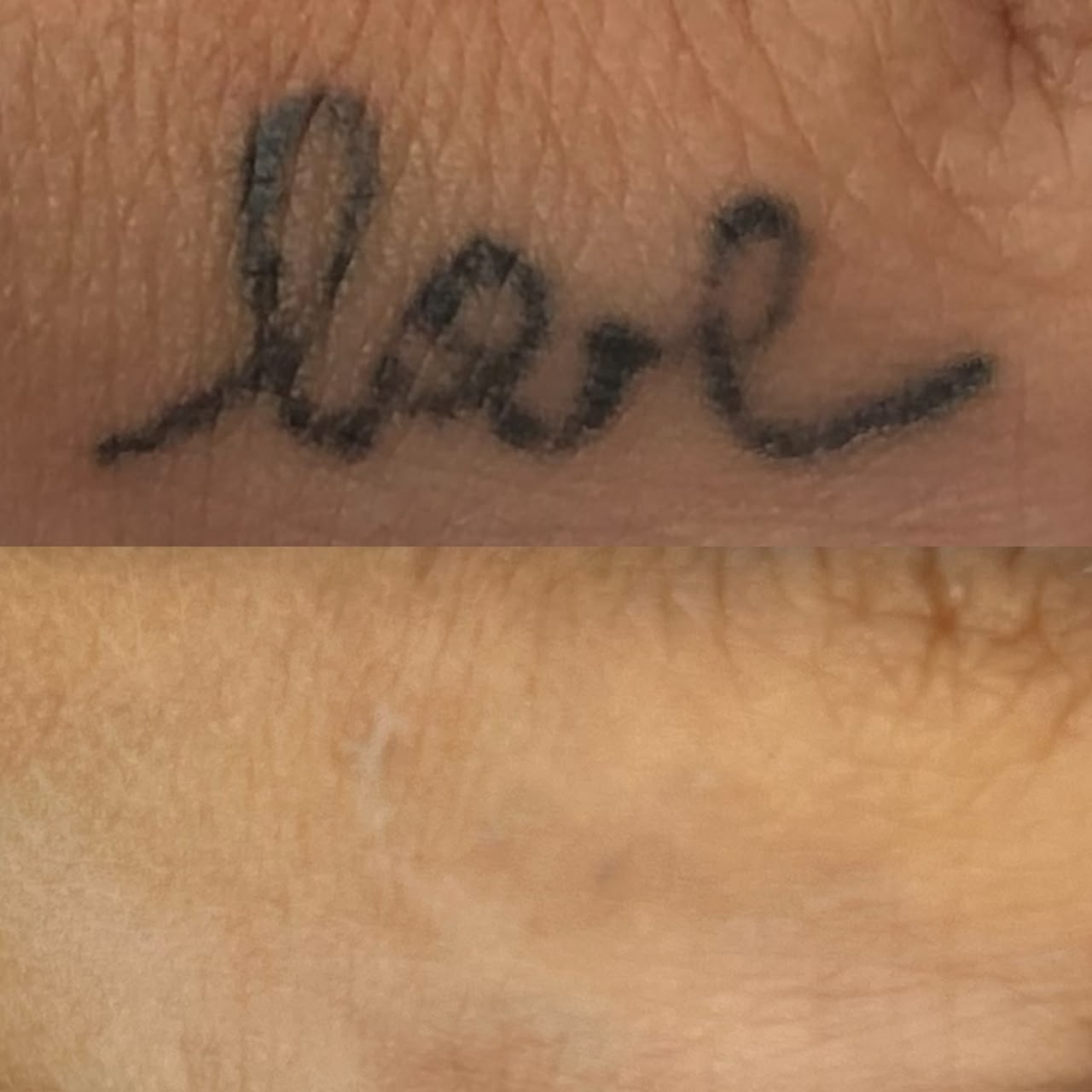 Remoção a Laser: Clareamento de tatuagem