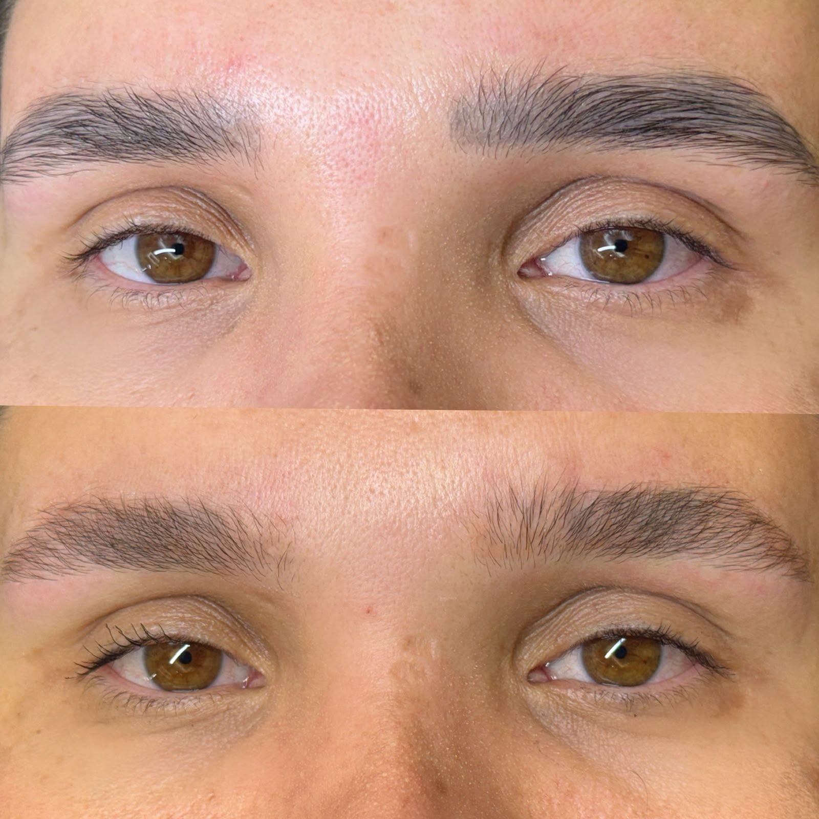 Remoção a Laser: Clareamento de pigmento antigo