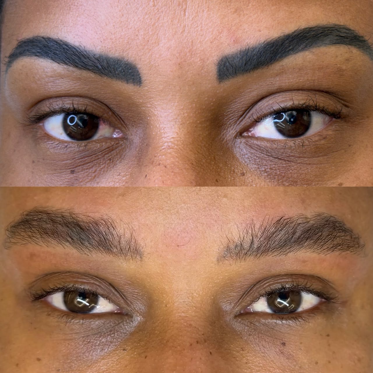 Remoção a Laser: Evolução de pigmento antigo