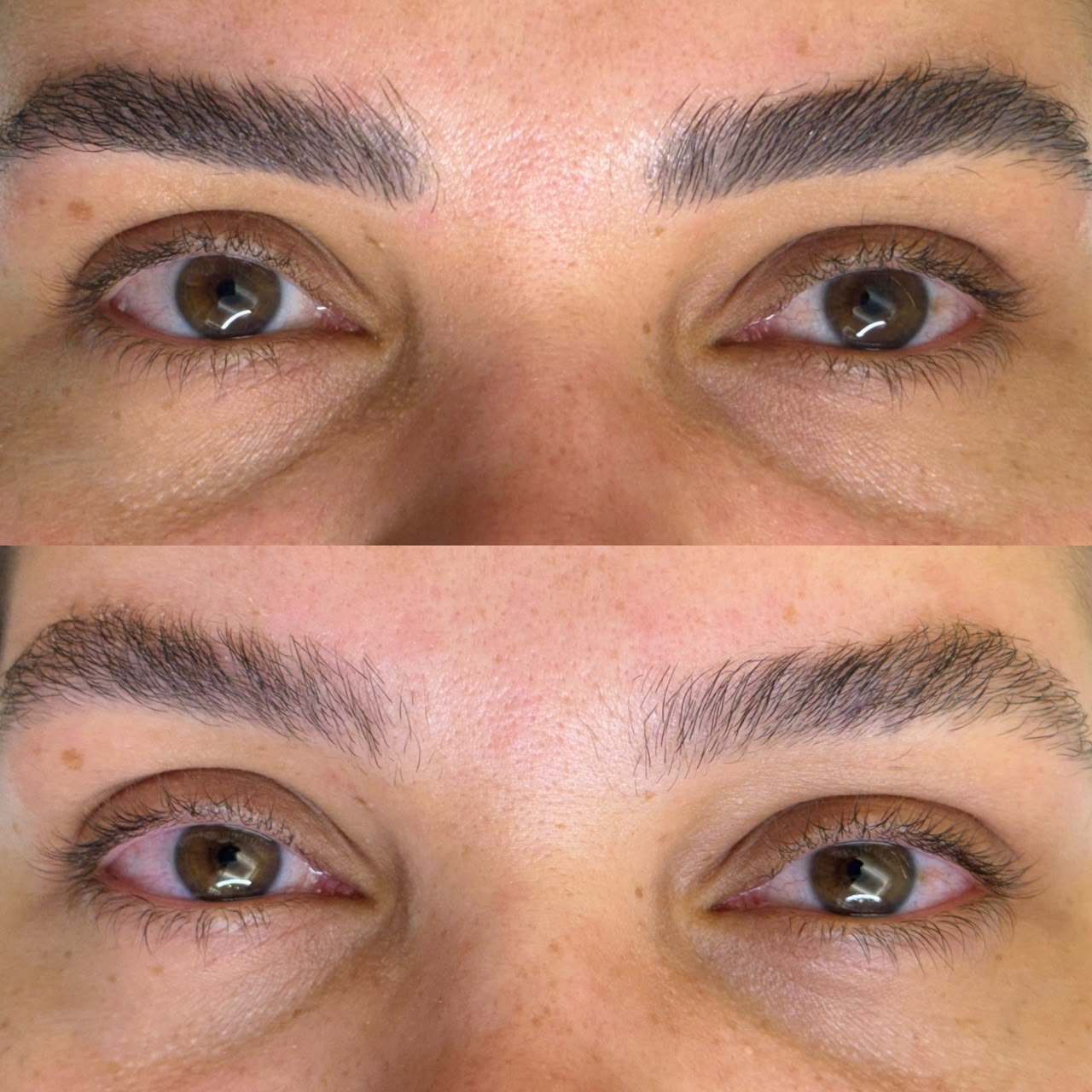 Remoção a Laser: Evolução entre sessões