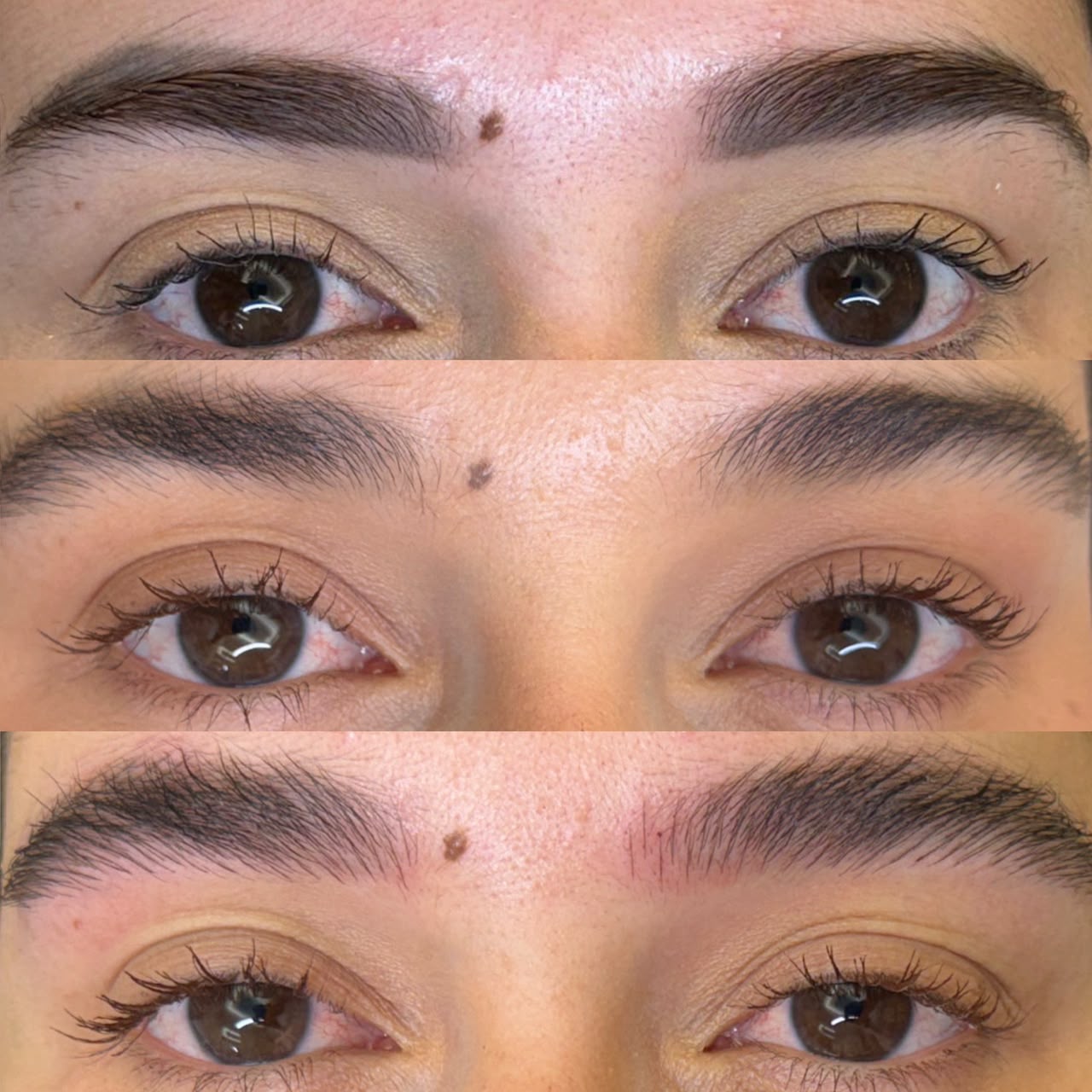 Remoção a Laser: Remoção de micropigmentação